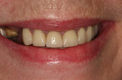 Dental implant before front podilsky