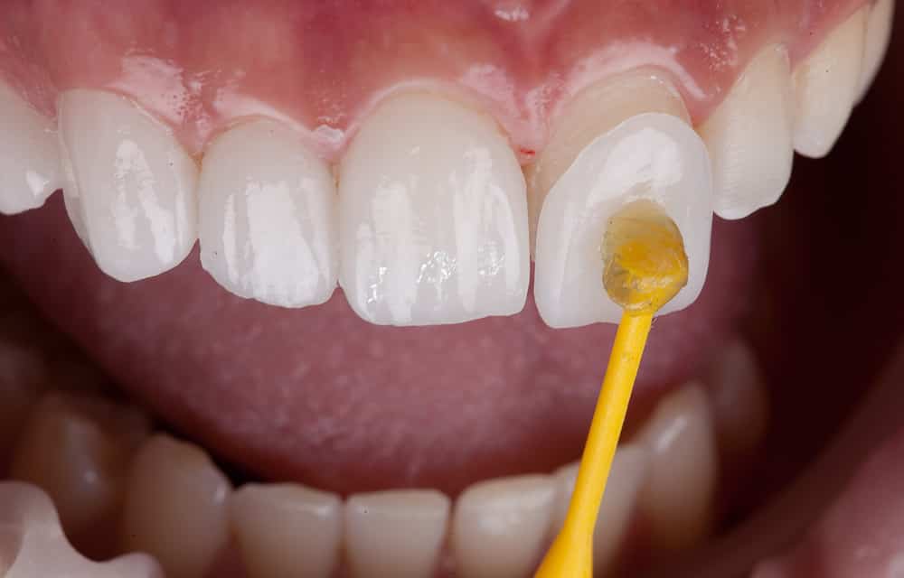 A close up photo of a mouth while installing temporary veneers