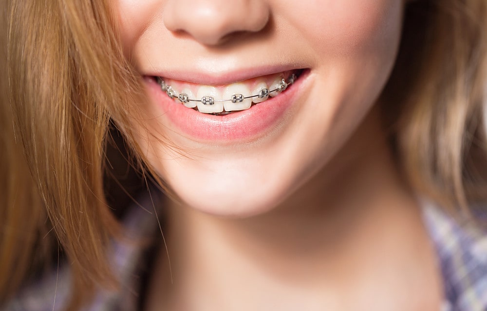 Close up portrait of smiling teen girl showing dental braces.