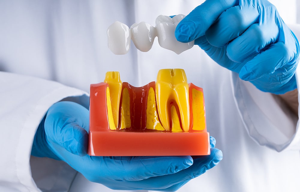 Dental implant bridges